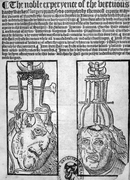 woodcut of trepanation